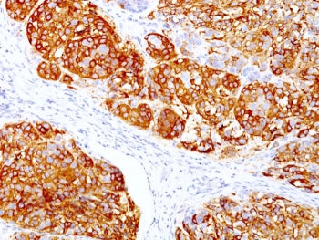 IHC staining of FFPE human melanoma with MART-1 antibody cocktail (clones DT101 + BC199). HIER: boil