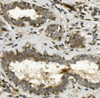 IHC staining of FFPE human breast cancer with TEAD2 antibody. HIER: boil tissue sections in pH8 EDTA