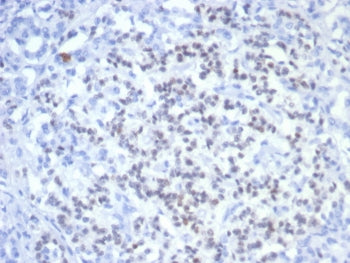 IHC staining of FFPE human pancreatic cancer with PAX6 antibody (clone PAX6/7707). HIER: boil tissue