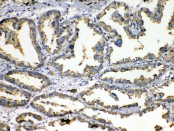 IHC testing of FFPE human lung cancer tissue with SOD3 antibody at 1ug/ml. Required HIER: steam sect