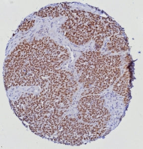 IHC staining of FFPE human prostate tissue with ETS-related gene antibody (clone ERG/6980) at 2ug/ml