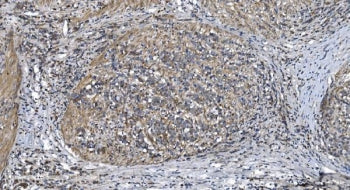 IHC staining of FFPE human gallbladder adenocarcinoma tissue with STIL antibody. HIER: boil tissue s