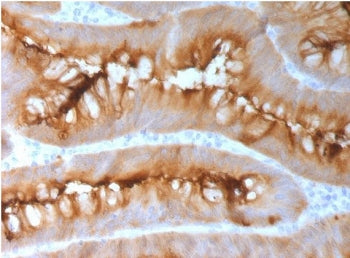 IHC testing of FFPE human melanoma with CEA antibody (clone CCAM5-2R). Required HIER: boil tissue se