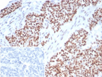 IHC staining of FFPE human ovarian carcinoma tissue with recombinant p53 antibody (clone TP53/7082R)