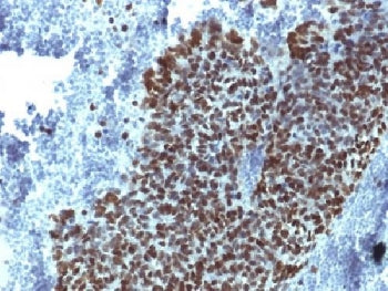 IHC testing of FFPE human prostate carcinoma with FOXA1 antibody (clone FOXA1/1514). HIER: boil sect