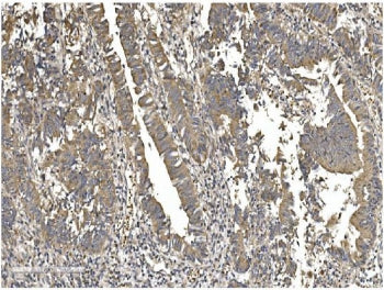 IHC staining of FFPE human rectal cancer with Gasdermin D antibody. HIER: boil tissue sections in pH
