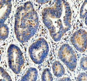 IHC staining of FFPE human stomach cancer tissue with Flotillin 1 antibody. HIER: boil tissue sectio