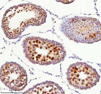 Immunohistochemical staining of BCCIP using anti-BCCIP antibody. BCCIP was detected in a paraffin-em