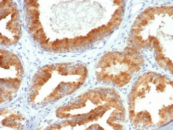 IHC staining of FFPE human prostate cancer tissue with CREB3L4 antibody (clone PCRP-CREB3L4-1A3). HI