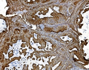 IHC staining of FFPE human ovarian adenocarcinoma tissue with PDIR antibody. HIER: boil tissue secti
