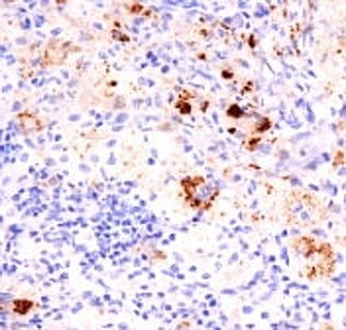 IHC: Formalin-fixed, paraffin-embedded human Erdheim Chester disease (also known as polyostotic scle