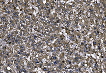 IHC staining of FFPE human liver cancer tissue with MENA antibody. HIER: boil tissue sections in pH8