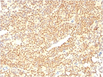 IHC staining of FFPE human mantle cell carcinoma with Cyclin D1 antibody (clone CCND1/2593). HIER: b