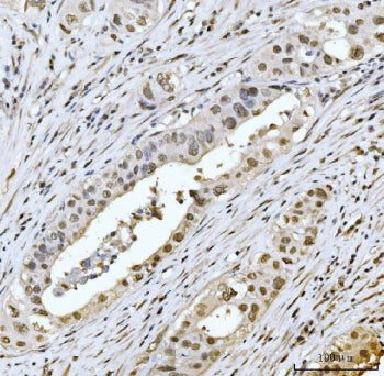 IHC staining of FFPE human appendiceal adenocarcinoma tissue with Meiotic recombination 11 antibody.