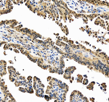 IHC staining of FFPE human ovarian cancer tissue with PSMC1 antibody, HRP-secondary and DAB substrat