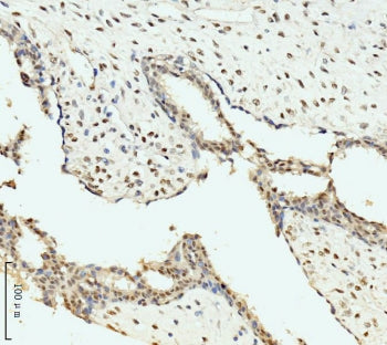 IHC staining of FFPE human breast cancer tissue with AKAP 95 antibody. HIER: boil tissue sections in
