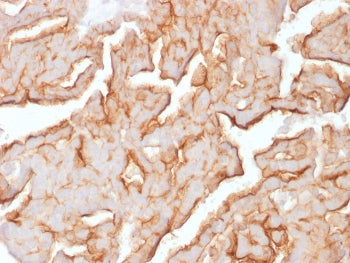 IHC staining of FFPE human ovarian carcinoma with recombinant MUC16 antibody (clone OCA125/1900). HI