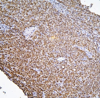IHC staining of FFPE human sarcoma with BHC80 antibody. HIER: boil tissue sections in pH6, 10mM citr