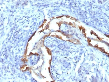 IHC: Formalin-fixed, paraffin-embedded human lung carcinoma stained with Cytokeratin 8 antibody (clo