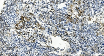 IHC staining of FFPE human liver cancer with TMBIM1 antibody. HIER: boil tissue sections in pH8 EDTA