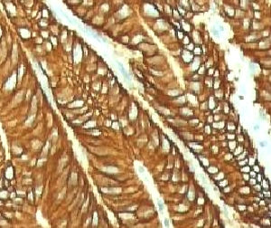 IHC testing of FFPE human colon carcinoma and EpCAM antibody (EPM17-1). FFPE testing requires sectio