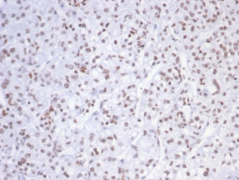 IHC staining of FFPE human kidney carcinoma tissue with SMARCAL1 antibody (clone PCRP-SMARCAL1-1C4).