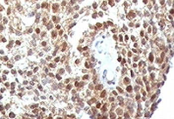 IHC: Formalin-fixed, paraffin-embedded human colon carcinoma stained with anti-p53 antibody (clone S