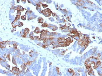 IHC staining of FFPE human prostate tissue with Cytokeratin 17 antibody (clone KRT17/4604). HIER: bo
