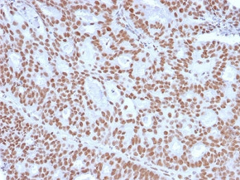 IHC staining of FFPE human endometrial carcinoma with Progesterone Receptor antibody (clone PGR/2694