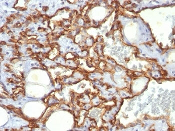 IHC: Formalin-fixed, paraffin-embedded human Angiosarcoma stained with anti-CD31 antibody (clone SPM