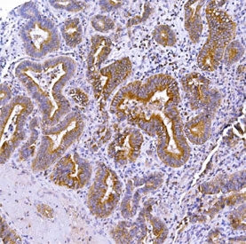 IHC staining of FFPE human adenosquamous carcinoma of the gall bladder with Optineurin antibody. HIE