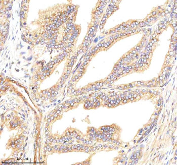 Immunohistochemical staining of GBF1 using anti-GBF1 antibody. GBF1 was detected in a paraffin-embed