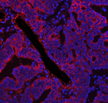 Immunofluorescent staining of FFPE human ovarian cancer tissue with FASN antibody (red) and DAPI nuc