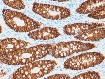 IHC staining of FFPE human colon carcinoma with biotinylated EpCAM antibody (clone VU-1D9). HIER: bo