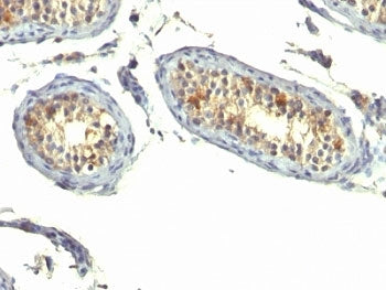 IHC: Formalin-fixed, paraffin-embedded human testicular carcinoma stained with TGF-alpha antibody (c