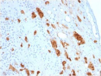 IHC testing of FFPE human mesothelioma with Calbindin 2 antibody (clone CALB2/2807). HIER: boil tiss