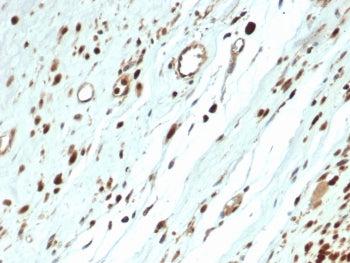 IHC staining of FFPE human rhabdomyosarcoma with recombinant MyoD1 antibody (clone MYOD1/3418R) at 2