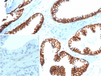 IHC staining of FFPE human prostate carcinoma tissue with Beta Catenin antibody (clone CTNNB1/6807R)
