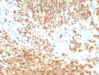 IHC staining of FFPE human melanoma tissue with PRAME antibody (clone PRAME/8558R). HIER: boil tissu