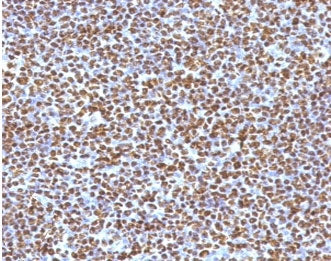 IHC testing of FFPE anaplastic large-cell lymphoma with ALK antibody (clone ATKR-1). HIER: boil tiss