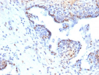 IHC staining of FFPE human colon carcinoma with RAD51 antibody. HIER: boil tissue sections in pH6, 1