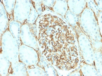 IHC testing of FFPE human renal cell carcinoma with recombinant CD34 antibody (clone HPCA1/2598R). R