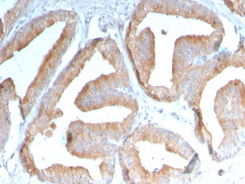 IHC staining of FFPE human prostate carcinoma with ICOSLG antibody (clone ICOSL/3111). HIER: boil ti