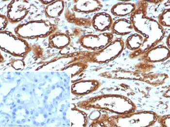 IHC staining of FFPE human renal cell carcinoma tissue with recombinant Calnexin antibody (clone CAN