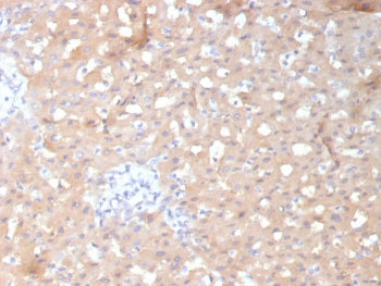 IHC staining of FFPE human hepatocellular carcinoma tissue with ADH1L1 antibody (clone ALDH1L1/7970)
