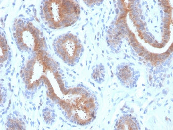 IHC staining of FFPE human breast carcinoma with recombinant Mammaglobin antibody (clone rMGB/4299).