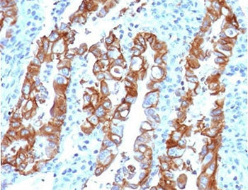 IHC testing of FFPE human colon carcinoma with TROP2 antibody (clone TCSR2-1). Required HIER: boil t