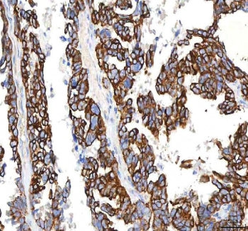 IHC staining of FFPE human mucinous adenoma of the ovary tissue with PKDCC antibody. HIER: boil tiss