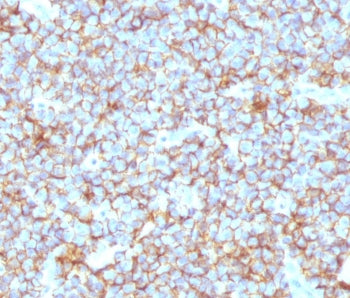 IHC testing of FFPE human Ewing's sarcoma with recombinant CD99 antibody (clone CDLA99-2R). Required