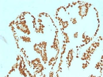 IHC testing of FFPE human prostate carcinoma with FOXA1 antibody (clone FOXA1/1515). HIER: boil sect